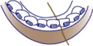 flossing-braces.jpg